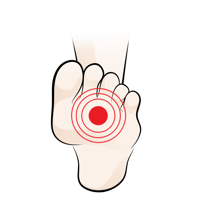 Ball of Foot pain (Metatarsalgia): Causes and Treatment Footlogics