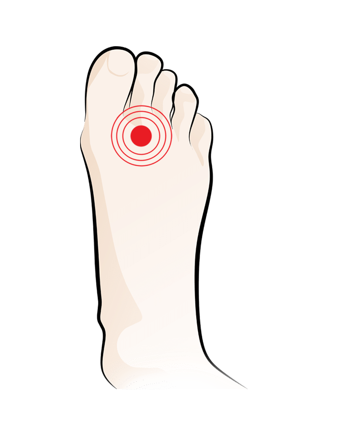 Morton's Neuroma: Symptoms, Causes and Treatment Footlogics